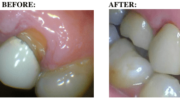 The Black Line Syndrome